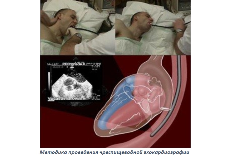 Методика проведения чреспищеводной эхокардиографии