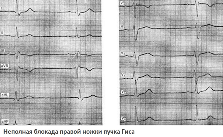 Неполная блокада правой ножки пучка Гиса