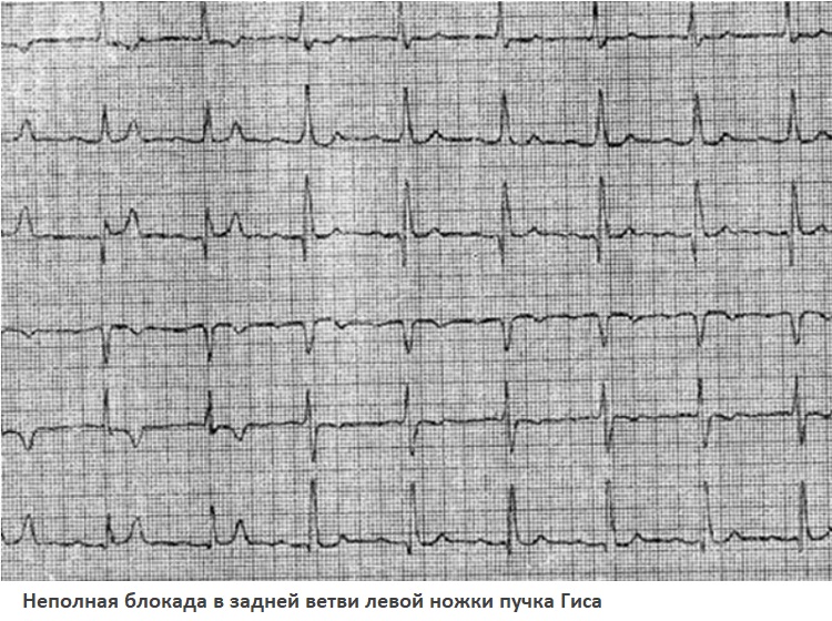 Неполная блокада в задней ветви левой ножки пучка Гиса 