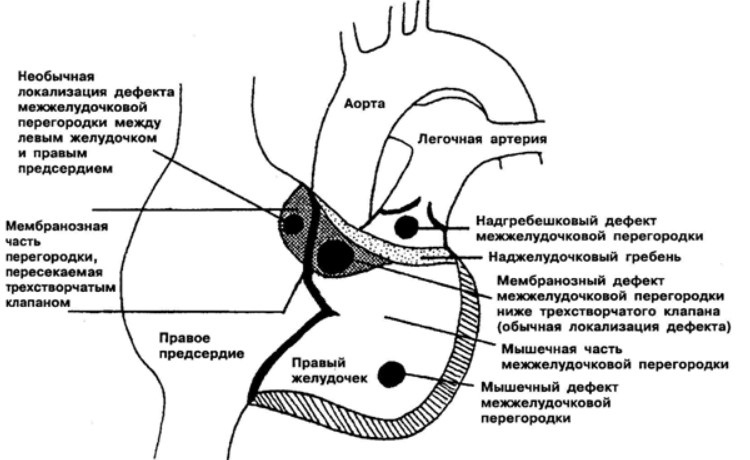 Перимембранозный дефект межжелудочковой перегородки