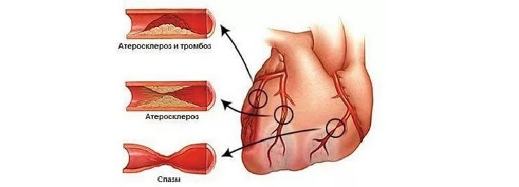 Спазм сосудов