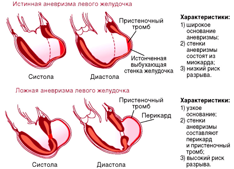 Картине истинной аневризмы в области верхушки миокарда левого желудочка соответствует