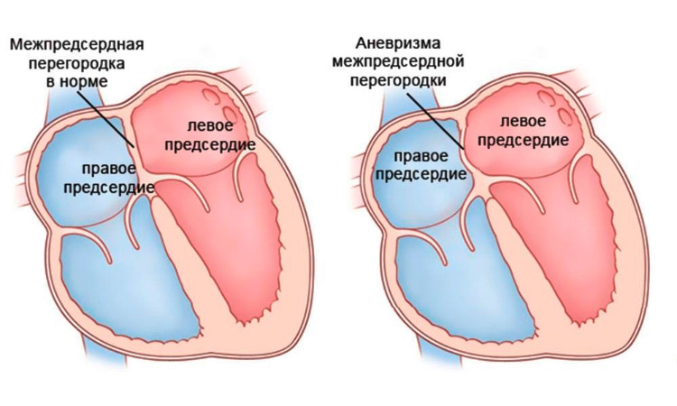 Физиология аневризмы