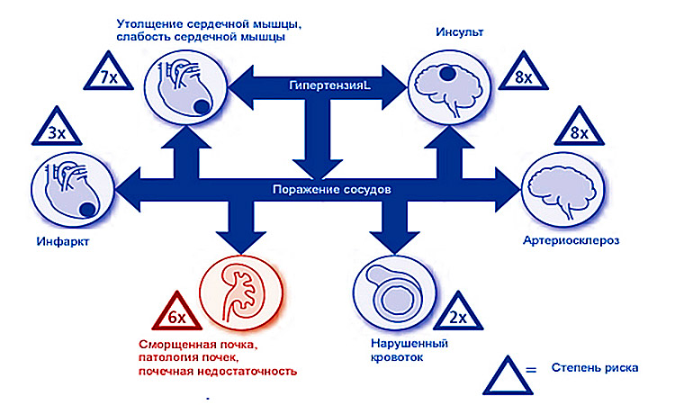 Гипертензия