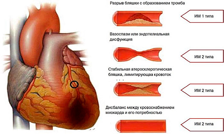 Изменения миокарда