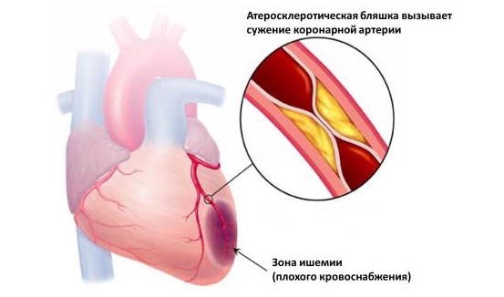 Ишемические изменения