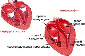 Гипертрофия левого желудочка сердца