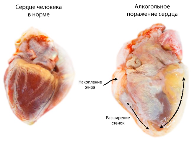 Как влияет алкоголь на сердце