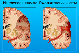 Инсульт при ВСД