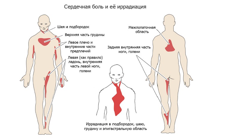 Иррадиация болей в сердце