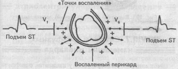 Фибринозный перикардит