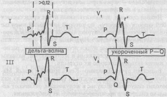 ЭКГ при синдроме WPW, тип А