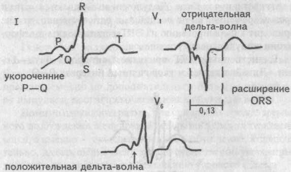 ЭКГ при синдроме WPW, тип В