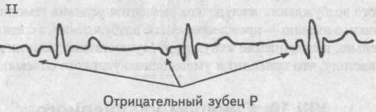 Атриовентрикулярный ритм