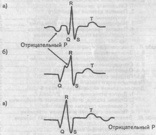 Расположение отрицательного зубца Р