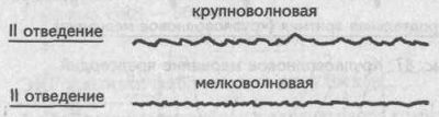 Фибрилляция желудочков