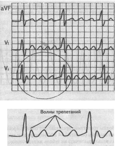 Трепетание предсердий