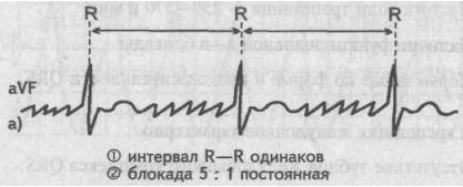 Регулярная форма трепетания предсердий