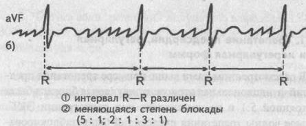 Нерегулярная форма трепетания предсердий