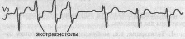 Групповые экстрасистолы