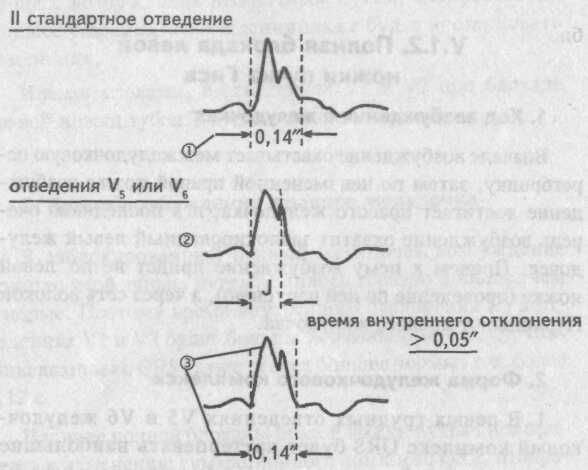 Нарушение внутрижелудочковой проводимости - Кардиолог - сайт о ...