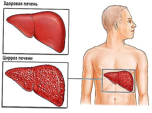 Проблемы с печенью