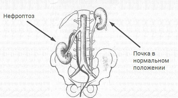 Нефроптоз