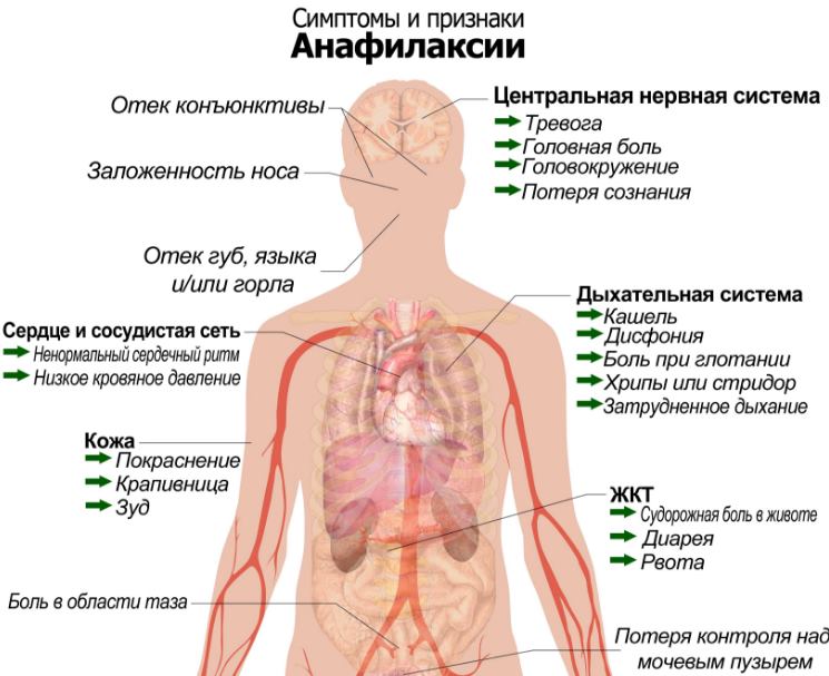 Анафилактический шок