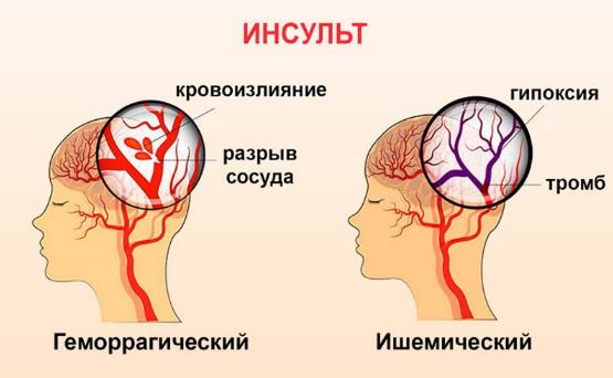 Виды инсультов