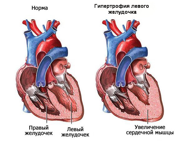 Увеличение левого желудочка