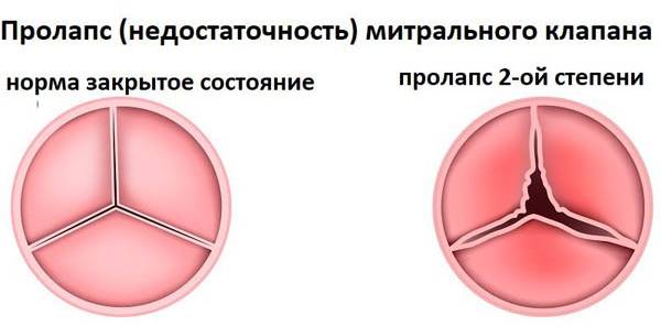 Пролапс митрального клапана 2 степени