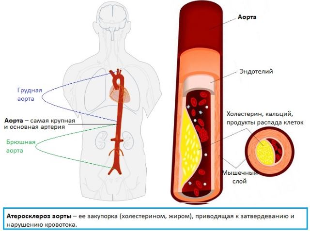 Склероз аорты