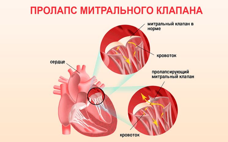 Пролапс митрального клапана