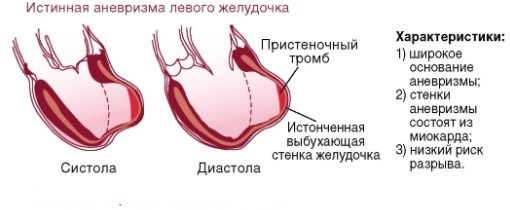 Атеросклеротические бляшки