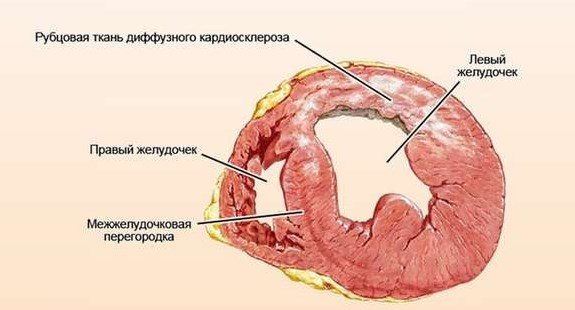 Обширный ПИКС