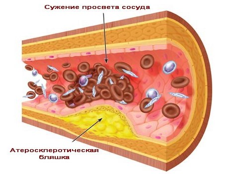 Атеросклеротические бляшки