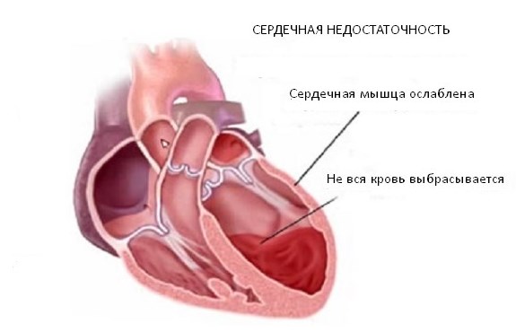 Сердечная недостаточность