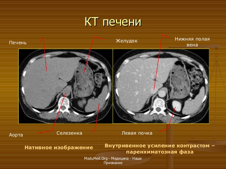 Сегменты печени кт схема