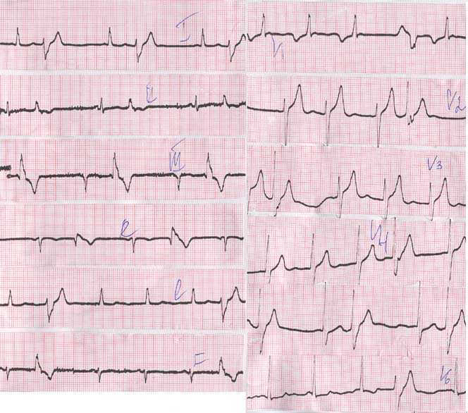 Кардиограмма при инсульте фото