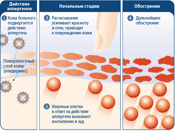 Механизм развития аллергии