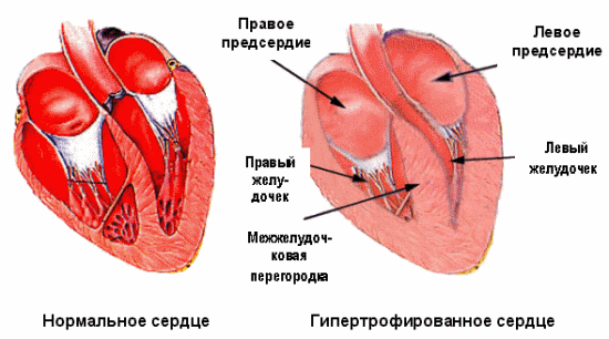 Гипертрофия сердца