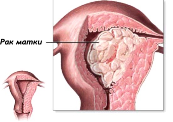 Рак матки