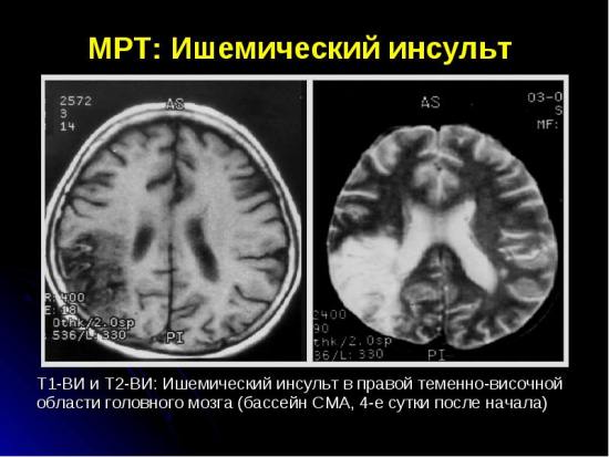 Инфаркт мозга