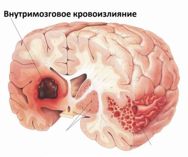 Почему после инсультов больные все время спят, последствия и отклонения