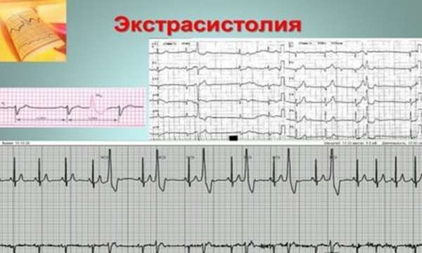 Особенности наджелудочковой экстрасистолии и ее лечение