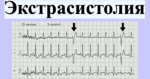 Как называется полоска сердцебиения на мониторе