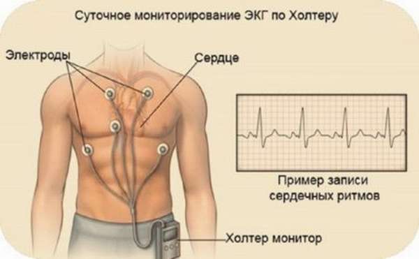 Особенности наджелудочковой экстрасистолии и ее лечение