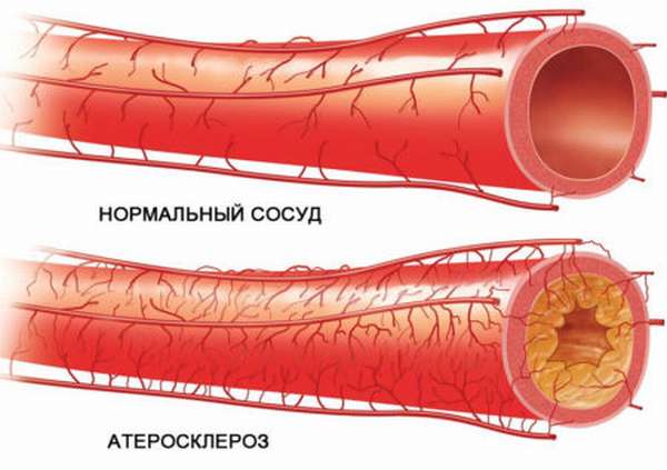 Почему нельзя самостоятельно назначать себе прием таблеток для чистки сосудов? Эффективность препаратов и противопоказания