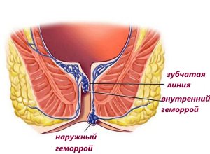Мазью Троксевазин лечат наружный геморрой