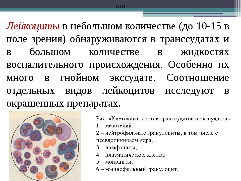 Лейкоциты в моче заболевания. Лейкоциты в моче 1/2 поля зрения. Лейкоциты в моче 2-3 в поле зрения. Лейкоциты микроскопия повышены. Лейкоциты в моче у ребенка 2.